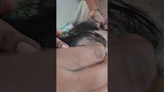 Recovery of alopecia assured natural amp permanent alopecia hair hairloss hairlossprevention [upl. by Aiepoissac]