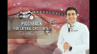 Double wire traction in orthodontics piggyback for lateral cross bite by Dr Amr Asker [upl. by Amby]