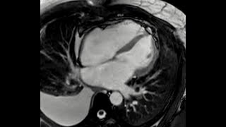 Cardiac Magnetic Resonance Showing Signs of Constrictive Physiology [upl. by Brenda315]