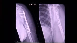 Simple or juvenile bone cyst in MRI scan by RadiologieTV [upl. by Chalmers481]