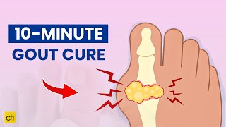 10Minute Gout Cure for Quick Relief and Recovery  Credihealth [upl. by Emse555]