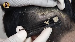 Scalp Psoriasis Scratching Black Hair  Dandruff Removal Satisfying [upl. by Aicela346]