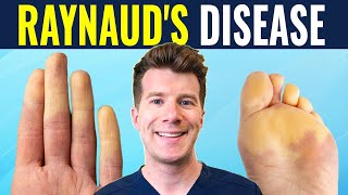 Doctor explains Raynauds disease and syndrome  Causes prevention and treatment [upl. by Anialeh]