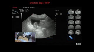 ipertrofia prostata sottoposta a TURP [upl. by Travus118]