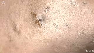 Big Cystic Acne Blackheads Extraction Blackheads amp Milia Whiteheads Removal Pimple Popping shorts [upl. by Laehcar]