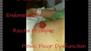 My Story Part 1 Endometriosis Rectal Prolapse Pelvic Floor Dysfunction amp Loop Ileostomy [upl. by Staw524]