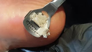 Pedicure  Pedicure At Home DIY Hard Dead Skin Removal [upl. by Iznil989]