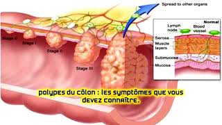 Polypes du côlon  les symptômes que vous devez connaître [upl. by Cynthla606]