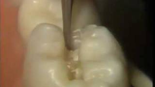 The Amalgam Proximal Box Cavity Preparation [upl. by Oremar581]