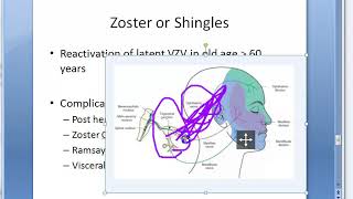 Microbiology 457 b Zoster Shingles VZV Varicella Zoster Virus ophthalmicus ramsay hunt acyclovir [upl. by Itisahc]