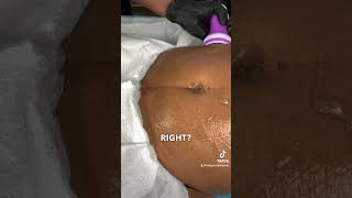 Body Sculpting Tip Lipo Cavitation Technique [upl. by Elsilrac]