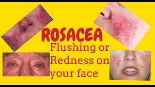 Rosacea or Potato nose or Rhinophyma or Redness of the face Phymatous rosacea Telangiectasia [upl. by Kauffmann631]