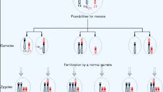 ROBERTSONIAN TRANSLOCATION FAMILIAL DOWN SYNDROME [upl. by Hsreh]