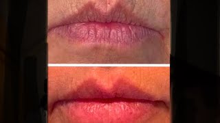 Lip filler  All on 6 implants  yay [upl. by Ylecic]