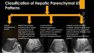 Liver Ultrasound Diffuse Disease Cirrhosis  fibrosis  Scoring  Hepatitis  Autoimmune  Contra [upl. by Berneta]