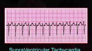 Introduction to EKG Rhythm Interpretation Part 3 [upl. by Trout887]