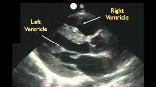 Cardiac Ultrasound  Parasternal Long Axis  Part 1  Sonosite Inc [upl. by Iglesias]