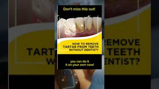 Removing Plaque From Teeth  How To Get Tartar off Teeth at Home tarta teeth dental [upl. by Enellek]