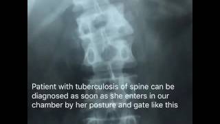 Infection amp Tuberculosis of Spine [upl. by Boelter806]