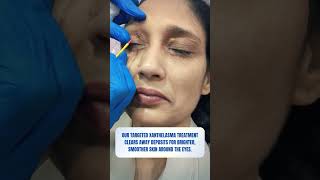 Xanthelasma Treatment  Skin Clinic  Kolkata  Skin Treatment  youtubereels youtubeshorts [upl. by Seek]