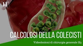 La calcolosi della colecisti eziologia diagnosi e terapia [upl. by Pellet]