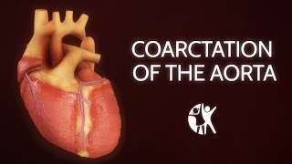 Coarctation of the Aorta [upl. by Atneuqal]