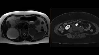 Fibromuscular dysplasia [upl. by Epuladaug432]