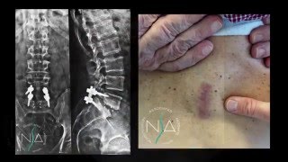 Spondilolistesi L5S1 artrodesi miniinvasiva tecnica MAS Plif  NSA Neurochirurgia [upl. by Izzy]