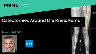 Osteotomies Around the Knee Femur  Taylor J Reif MD [upl. by Sihun]