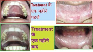 OSMF Early to Advance Stage Problem amppatient treatment resultOral Submucous Fibrosis and ulceration [upl. by Hayse]