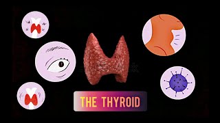 THYROID  HYPOTHYROIDISM Cretinism amp Myxedema [upl. by Charlotta]