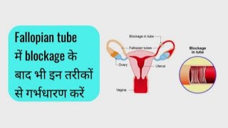 Fallopian tube blockage causes symptoms and treatment fallopiantubeblockage fallopiantube [upl. by Pammie]