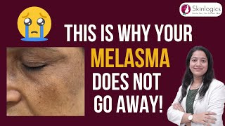 Melasma Mistakes to Avoid  Best Melasma Treatment in Noida  Skin Lightening Treatment in Noida [upl. by Ennaihs]