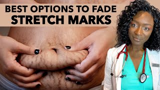 How To Remove Stretch Marks  Jism Ke Nishanat Ka Ilaj  Treatment Of Stretch Marks Kyun Hote Hain [upl. by Port]