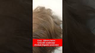 Griscelli syndrome  Chediak higashi syndrome HLH  Grey silvery in hairs kidsTests and treatment [upl. by Kammerer]