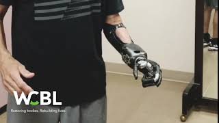 Myoelectric Upper Extremity Prosthetic Device [upl. by Jeanelle722]