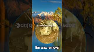 Removal of a strong large ear wax [upl. by Cris714]