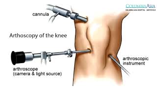 How long does it take to recover from Arthroscopic Knee Surgery [upl. by Cr]