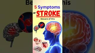 5 Symptoms of Stroke Beware of this [upl. by Shannen178]