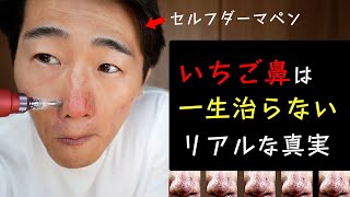 いちご鼻は一生治らないのか？セルフダーマペンで角栓除去してみた。 [upl. by Jeffry]