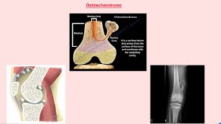 Orthopédie  ostéochondrome [upl. by Zysk]