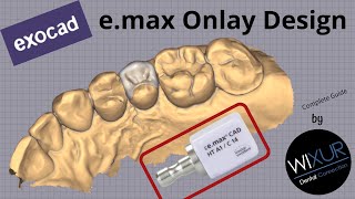 exocad emax Onlay Design [upl. by Eldwon285]