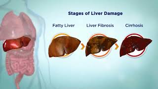 Hepatitis C HCV  Causes symptoms Diagnosis amp Treatment options [upl. by Doxia]