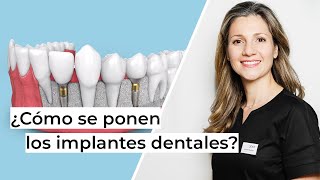 ¿Cómo se ponen los implantes dentales paso a paso  Clínica dental en Alcobendas Avodent [upl. by Emanuel139]