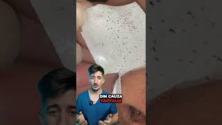 Puncte negre studentlamedicina beauty doctor skincare makeup pimple [upl. by Gabby]