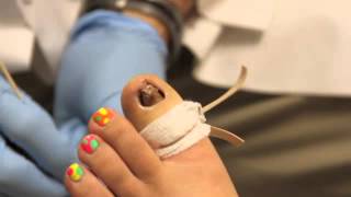 Toe Nail Removal [upl. by Vish]