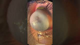 The Beautiful Cases Keratoconus Keratoglobus Corneal Hydrops [upl. by Saleme]