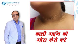 Acanthosis Nigircans Treatment  काली गर्दन को गोरा कैसे करे  In Hindi  Dr Rohit Batra [upl. by Agustin155]