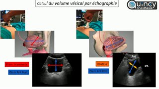 Evaluation du contenu vésical sous échographie [upl. by Keslie]