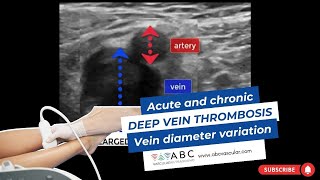 Acute and chronic Deep vein thrombosis Vein diameter variation  Ultrasound [upl. by Aierb]